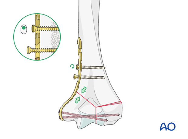 Supracondylar compression with eccentrically inserted cortical screw 