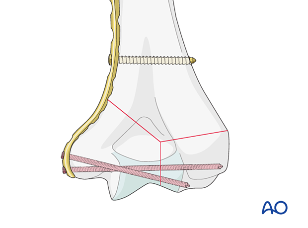 Long variable-angle screws engaging fragments on the opposite side to the plate