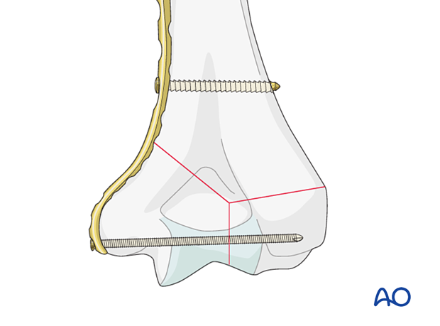 Metaphyseal screw through the plate