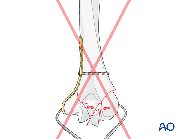 Overcompression of articular fragments in multifragmentary articular fractures