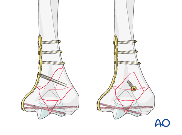 Lag screw compression outside or through the plate depending on the fracture plane