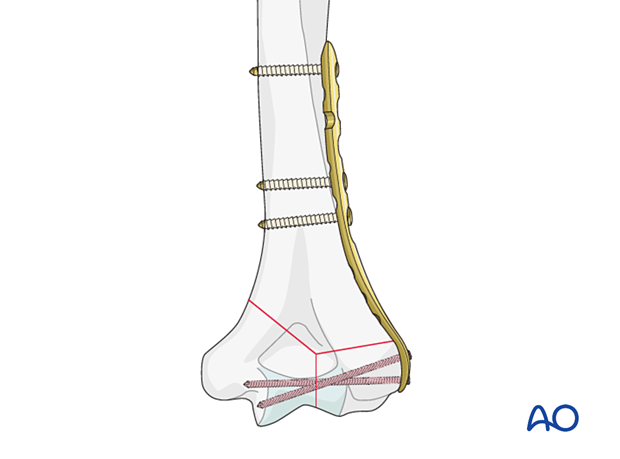 Lateral plating of distal humeral fracture