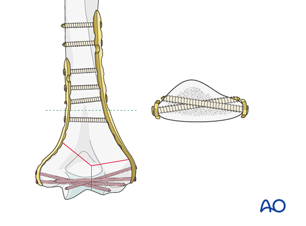 Parallel plating construct