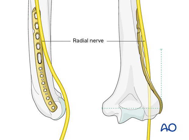 Radial nerve at risk with longer lateral plate