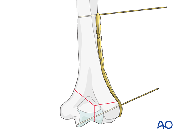 Placing the plate to the lateral aspect of the distal humerus along the supracondylar ridge