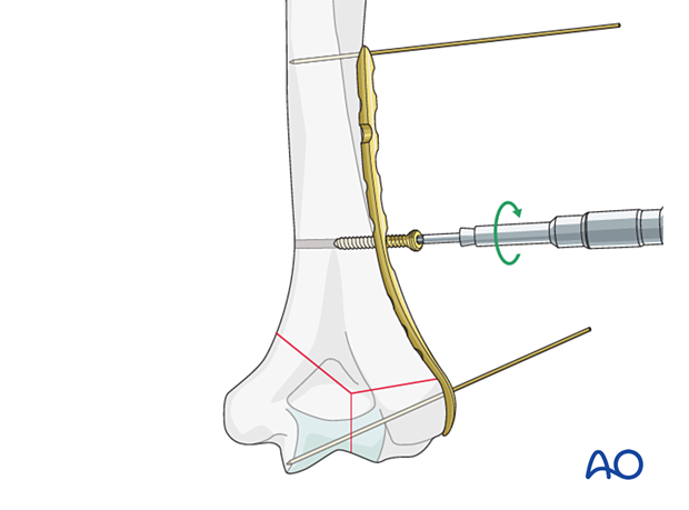 Provisional fixation of the plate to the bone with a cortical position screw through one of the combiholes proximal to the fracture zone