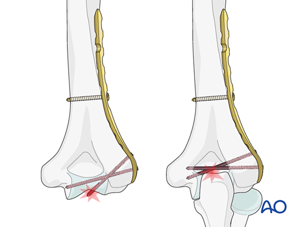 Articular penetration of screws and screws through the olecranon fossa