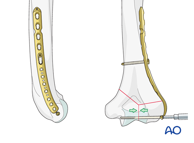 Intrinsic compression applied by insertion of a transverse lag screw separate to the plate