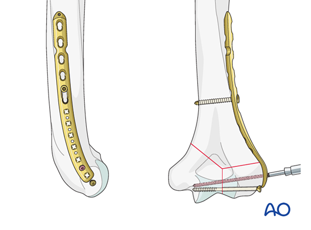 Adding a locking screw through the articular block