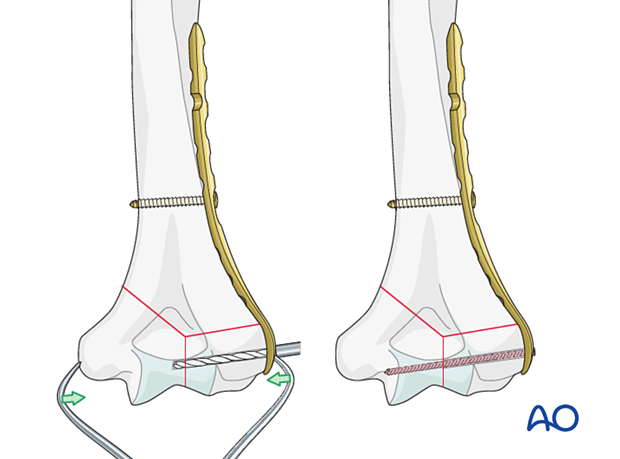 Extrinsic compression applied by a forceps and maintained with a locking screw through the plate