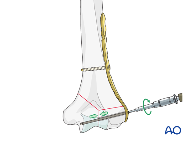 Intrinsic compression applied by insertion of a metaphyseal lag screw through the plate