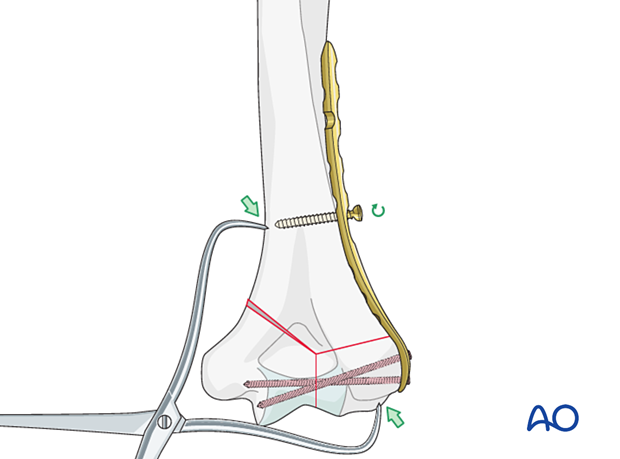 Supracondylar compression with forceps