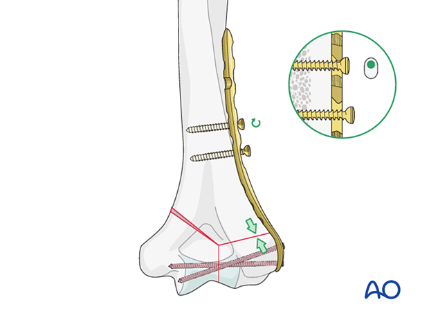 Supracondylar compression with eccentrically inserted cortical screw