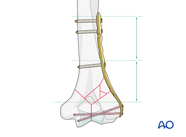 Bridge plating of complex column fracture with near-far screw insertion