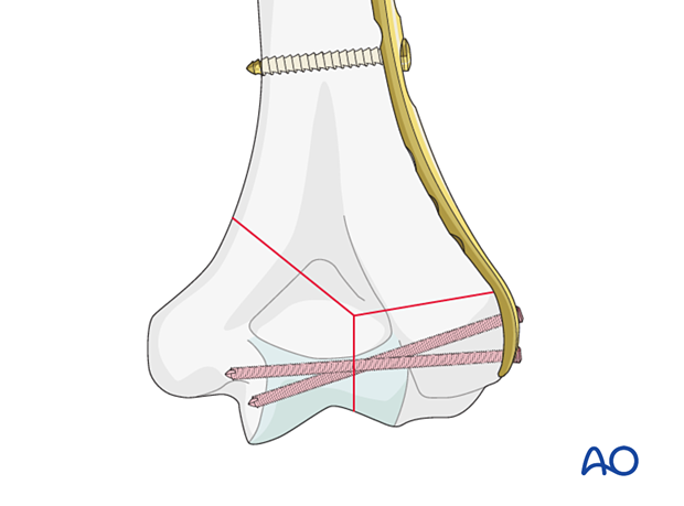 Long variable-angle screws engaging fragments on the opposite side to the plate