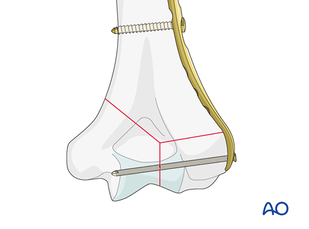 Metaphyseal screw through the plate