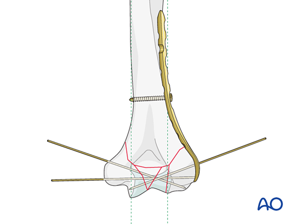 Reconstruction of the articular block with K-wires