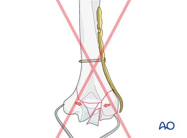 Overcompression of articular fragments in multifragmentary articular fractures