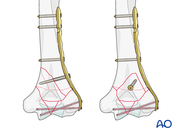 Lag screw compression outside or through the plate depending on the fracture plane