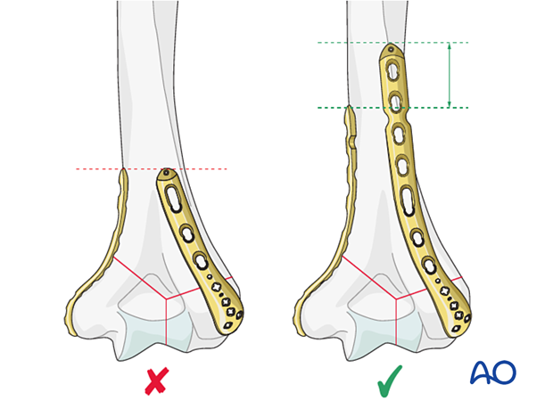 When using two plates, it is preferable to end the plates at different levels to avoid a stress riser.