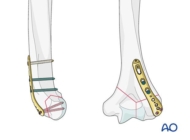 Dorsolateral plating of distal humeral fracture