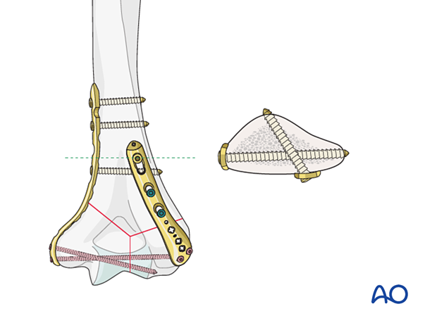 Perpendicular plating construct