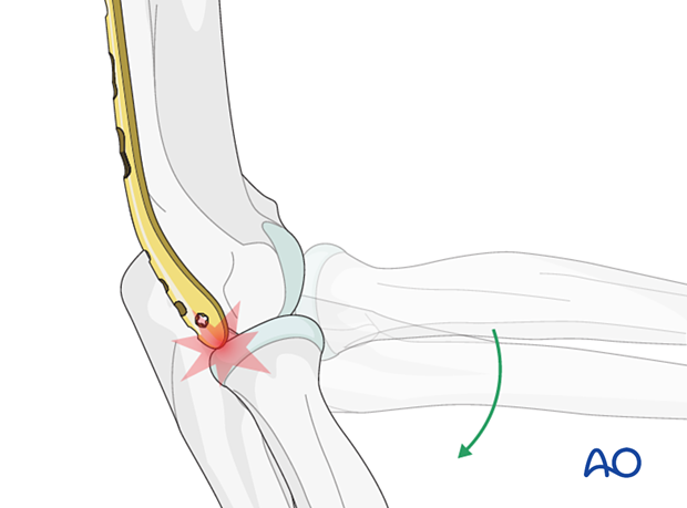 Plate impingement against the radial head in terminal elbow extension