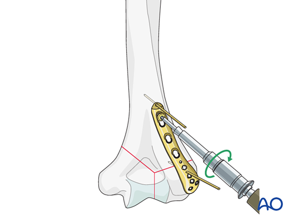 Provisional fixation of the plate to the bone with a cortical position screw through one of the combiholes proximal to the fracture zone