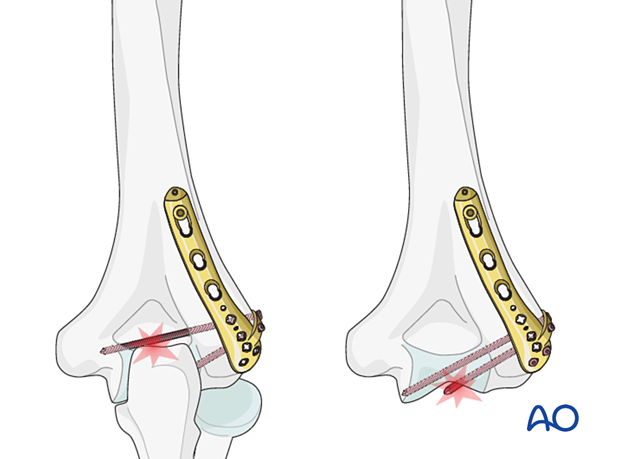 Articular penetration of screws and screws through the olecranon fossa