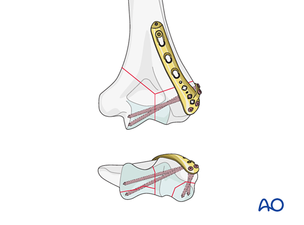 Long variable-angle screws through the lateral tab