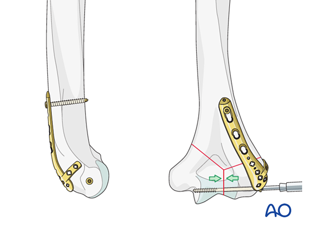 Intrinsic compression applied by insertion of a transverse lag screw separate to the plate