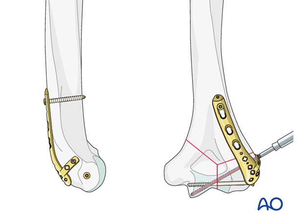 Adding a locking screw through the articular block