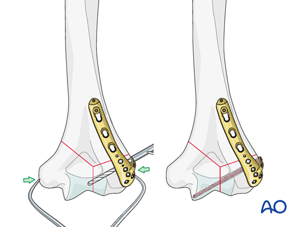 Extrinsic compression applied by a forceps and maintained with a locking screw through the plate