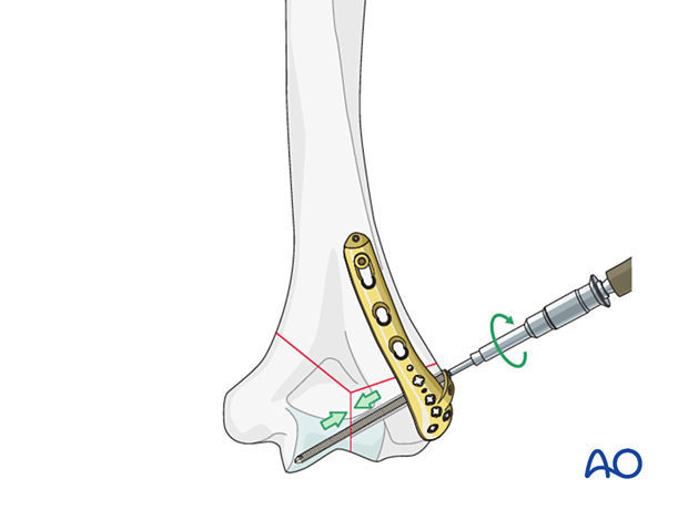 Intrinsic compression applied by insertion of a metaphyseal lag screw through the plate