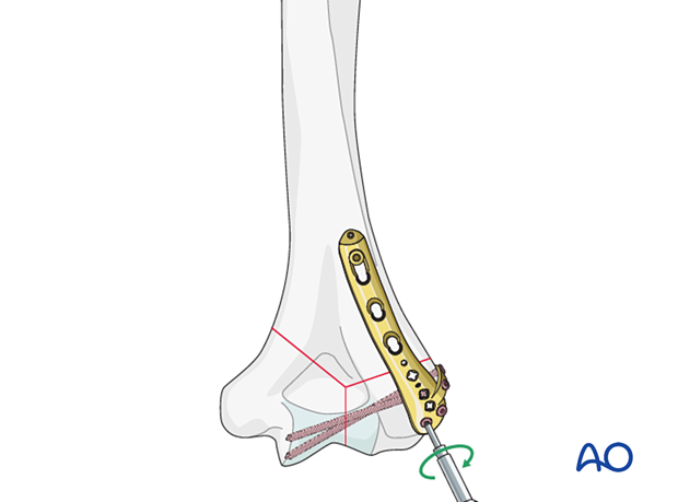 Insertion of posteroanterior locking screws