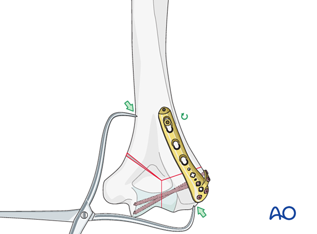 Supracondylar compression with forceps