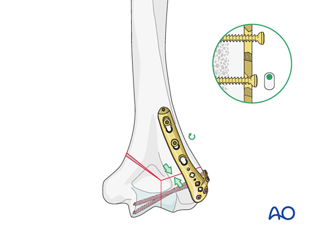 Supracondylar compression with eccentrically inserted cortical screw