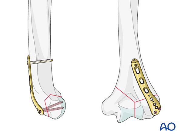 Screws should be long enough to engage fragments on the opposite side to the plate.