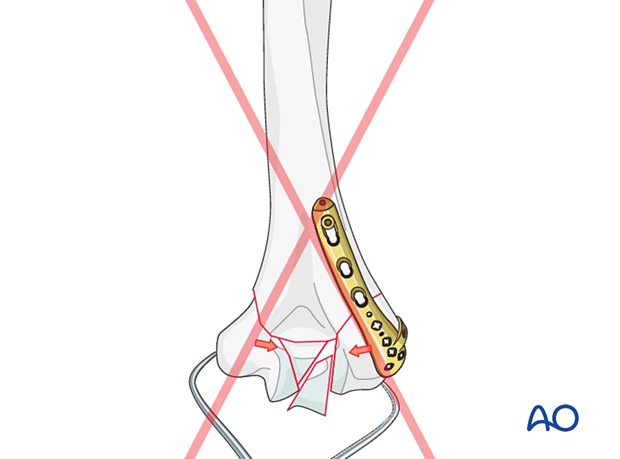 Overcompression of articular fragments in multifragmentary articular fractures