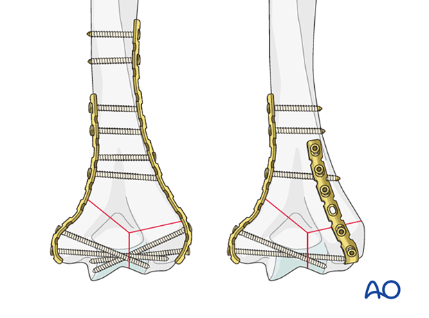 Bicolumnar plating of distal humeral fracture with reconstruction plates