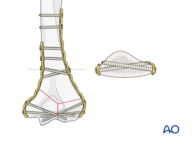 Parallel plating construct