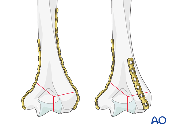 Placement of medial, lateral, and dorsolateral reconstruction plate