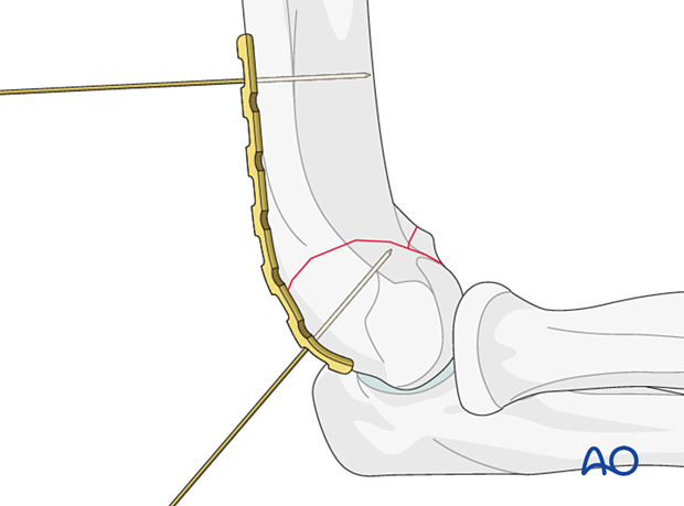 The dorsolateral plate may curve around the capitellum.