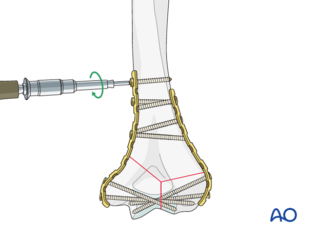 Inserting cortical plate screws in the proximal fragment