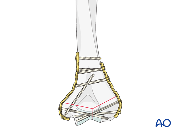 When the reassembled condylar mass is short and nonlocking plates are used, enhance the stability of the fixation with long, distal-to-proximal, 3.5 mm column screws.