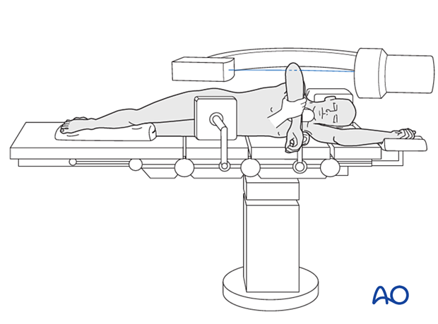 C-arm positioning for lateral images with the patient in lateral decubitus position