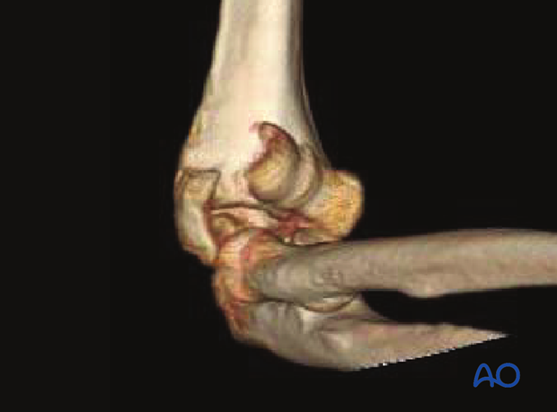 3-D CT reconstruction of a complex coronal fracture of capitellum and trochlea, involving a lateral epicondylar fracture, posterior impaction, and medial fracture extension