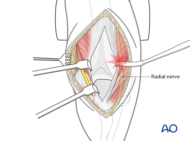 Working length of the radial nerve