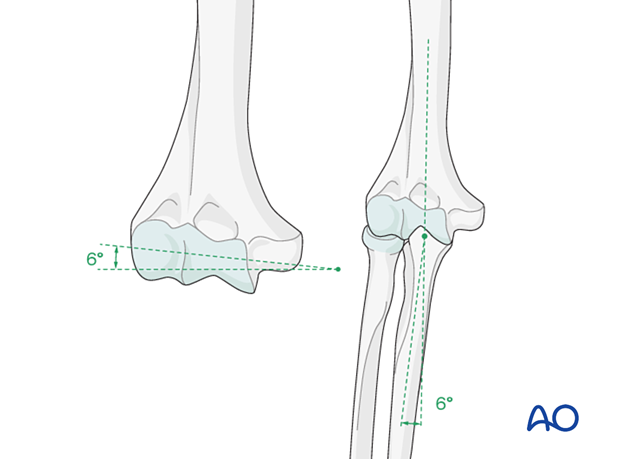 Normal valgus “carrying angle” of the elbow joint