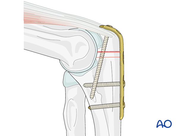 Plate fixation of olecranon osteotomy